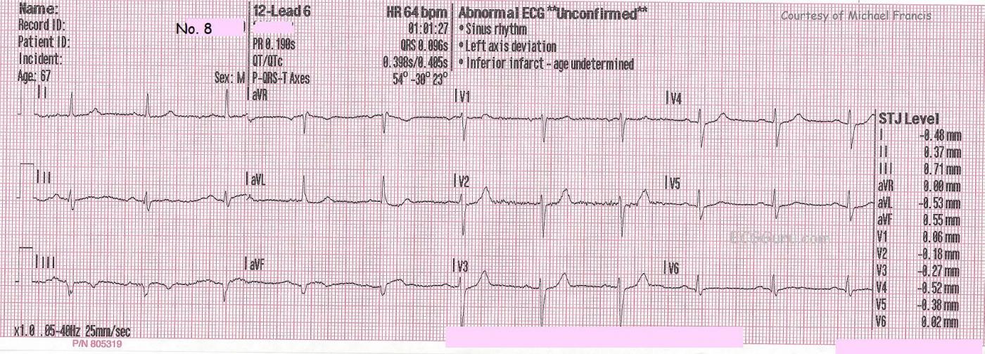 Teaching Series 112213 Inferior Posterior Wall M I With Right